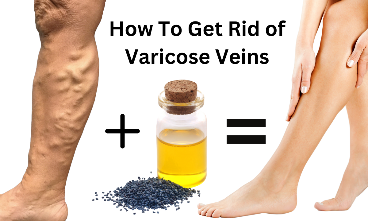 How To Get Rid of Varicose Veins